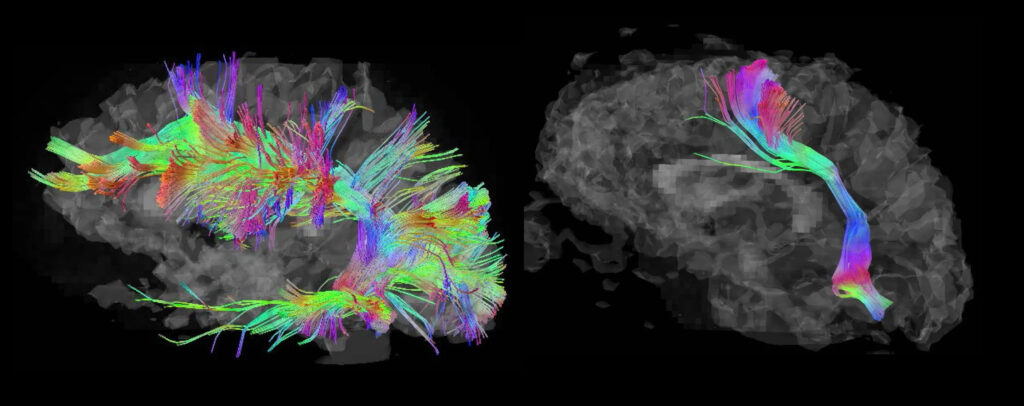 Two brain scans. The one on the left is a rainbow web reaching into all areas of the brain. The image on the right is a rainbow ribbon traveling along the language center of the brain.